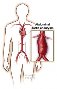 aortic aneurysm stent repair austin texas