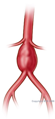 artery aneurysm aortic aneurysm
