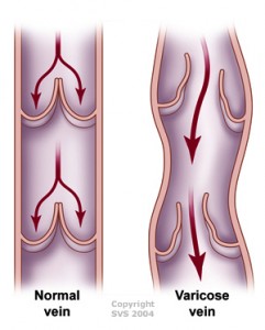 Varicose Vein Diagram