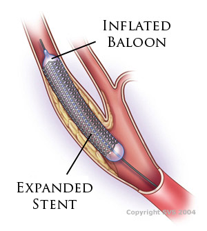 stents - cardio vascular surgeons austin