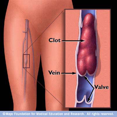 What symptoms does a blood clot in your groin cause?