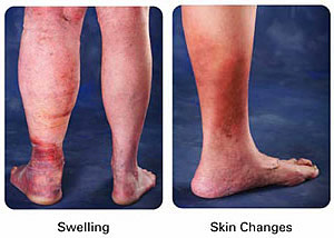 Can Swollen Legs & Feet Leave Feet Bruised 98