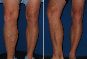 varicose vein leg swelling