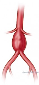 Artery Aneurysms