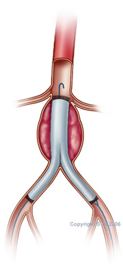 artery aneurysm stent surgery austin round rock tx