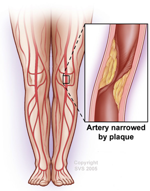 leg artery stents austin texas