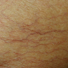 Spider Veins of Skin