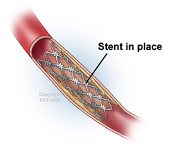 artery stent austin texas
