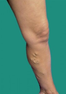 Typical Appearance of a Varicose Vein