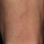 After Spider Vein Treatment