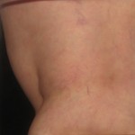 After Spider Vein Treatment