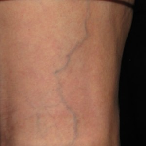 Before Spider Vein Treatment