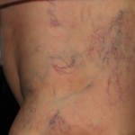 Before Spider Vein Treatment