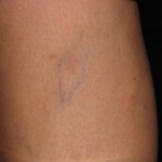 Before Spider Vein Treatment