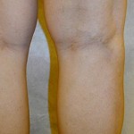 After Varicose Vein Treatment