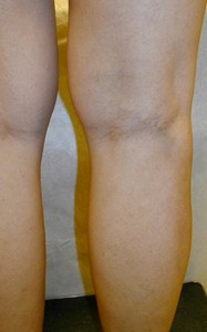 After Varicose Vein Treatment