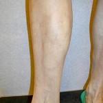 After Varicose Vein Treatment