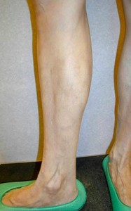 After Varicose Vein Treatment