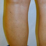 After Varicose Vein Treatment