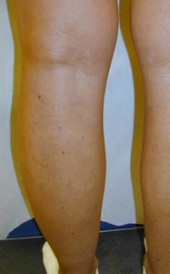 After Varicose Vein Treatment