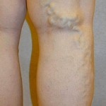 Before Varicose Vein Treatment