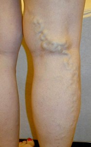 Before Varicose Vein Treatment