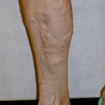 Before Varicose Vein Treatment