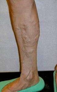 Before Varicose Vein Treatment