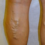 Before Varicose Vein Treatment