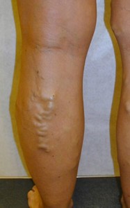 Before Varicose Vein Treatment