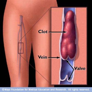 DVT Deep Venous Thrombosis - Austin Vascular Surgeons