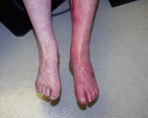 Vascular Surgeons - Leg Edema Treatment Austin | Leg Ankle Foot Swelling