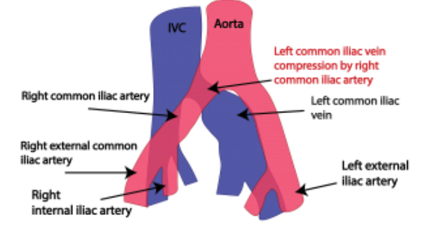 May Thurner Syndrome | Treatment of Iliac Vein Compression Syndrome