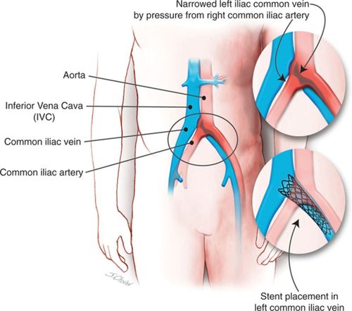 right common iliac artery