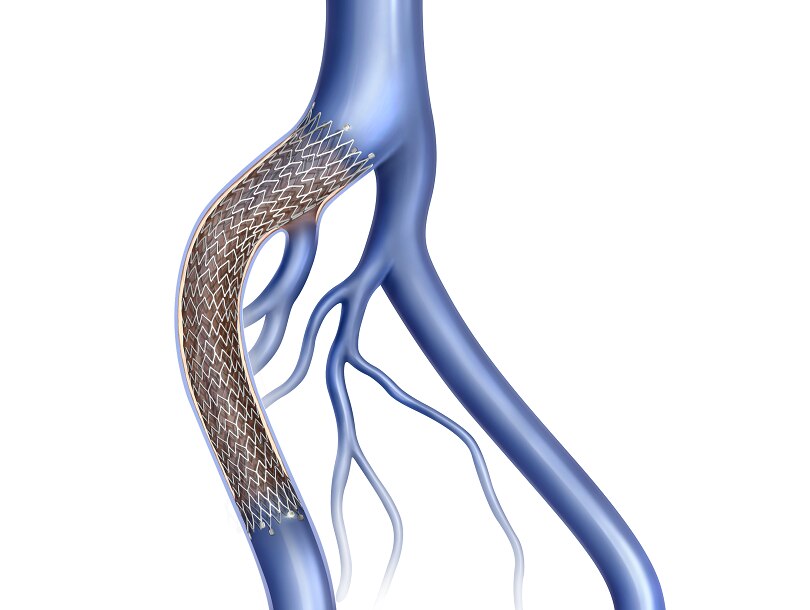 Vein Stents for May Thurner Syndrome